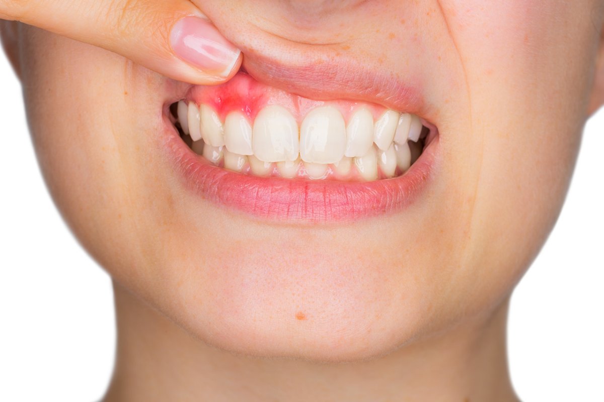woman-pointing-to-inflamed-gum
